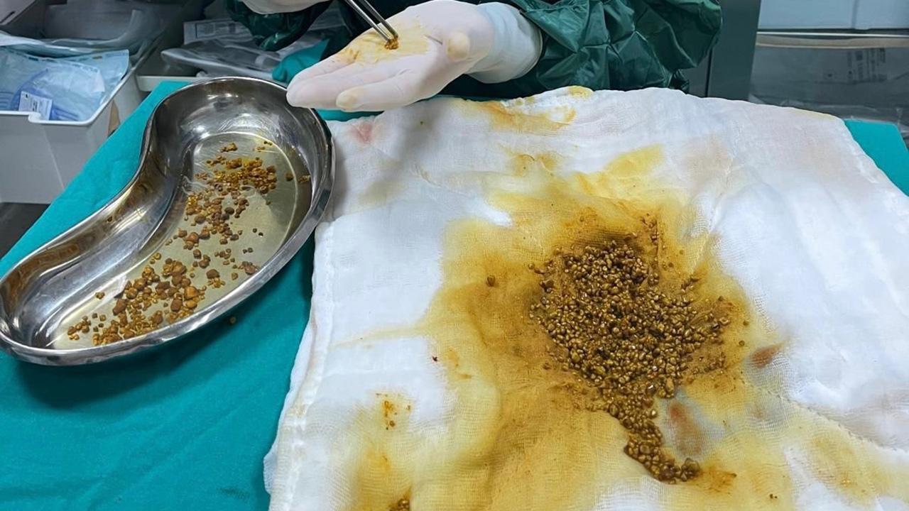 Hastanın ameliyatında 2 bin 67 taş çıkarıldı — Son Dakika haber görseli